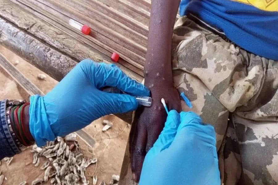 Alerta sanitaria mundial: OMS declara emergencia por Mpox en Congo