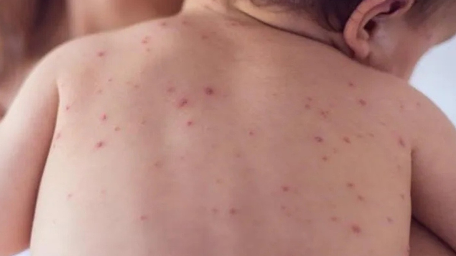 Oaxaca activa cerco sanitario por brote de sarampión en tres comunidades