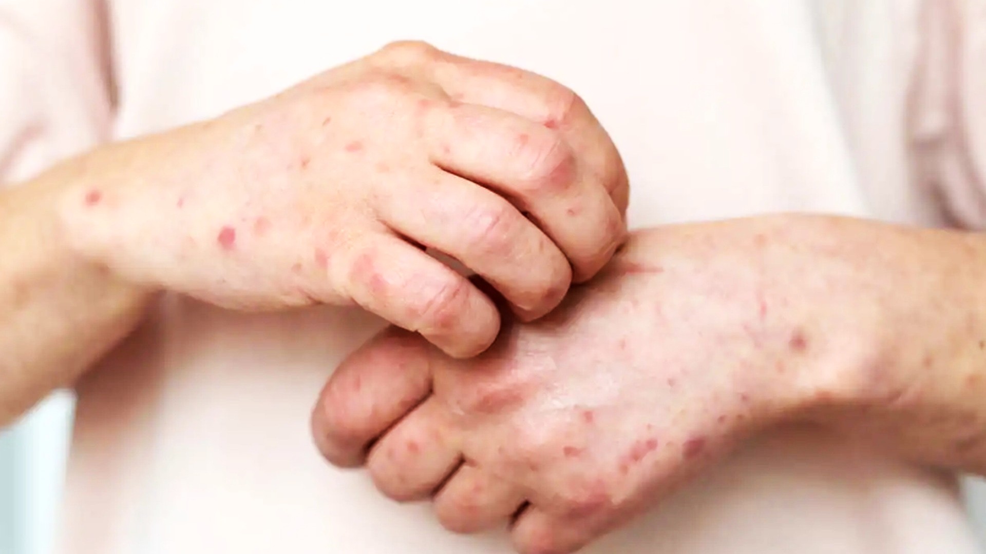 Sarampión en México: suman 8,899 casos confirmados y 28 muertes en 2025-2026