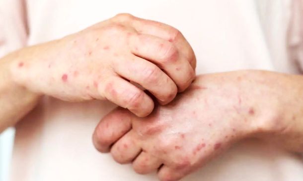 Sarampión en México: suman 8,899 casos confirmados y 28 muertes en 2025-2026