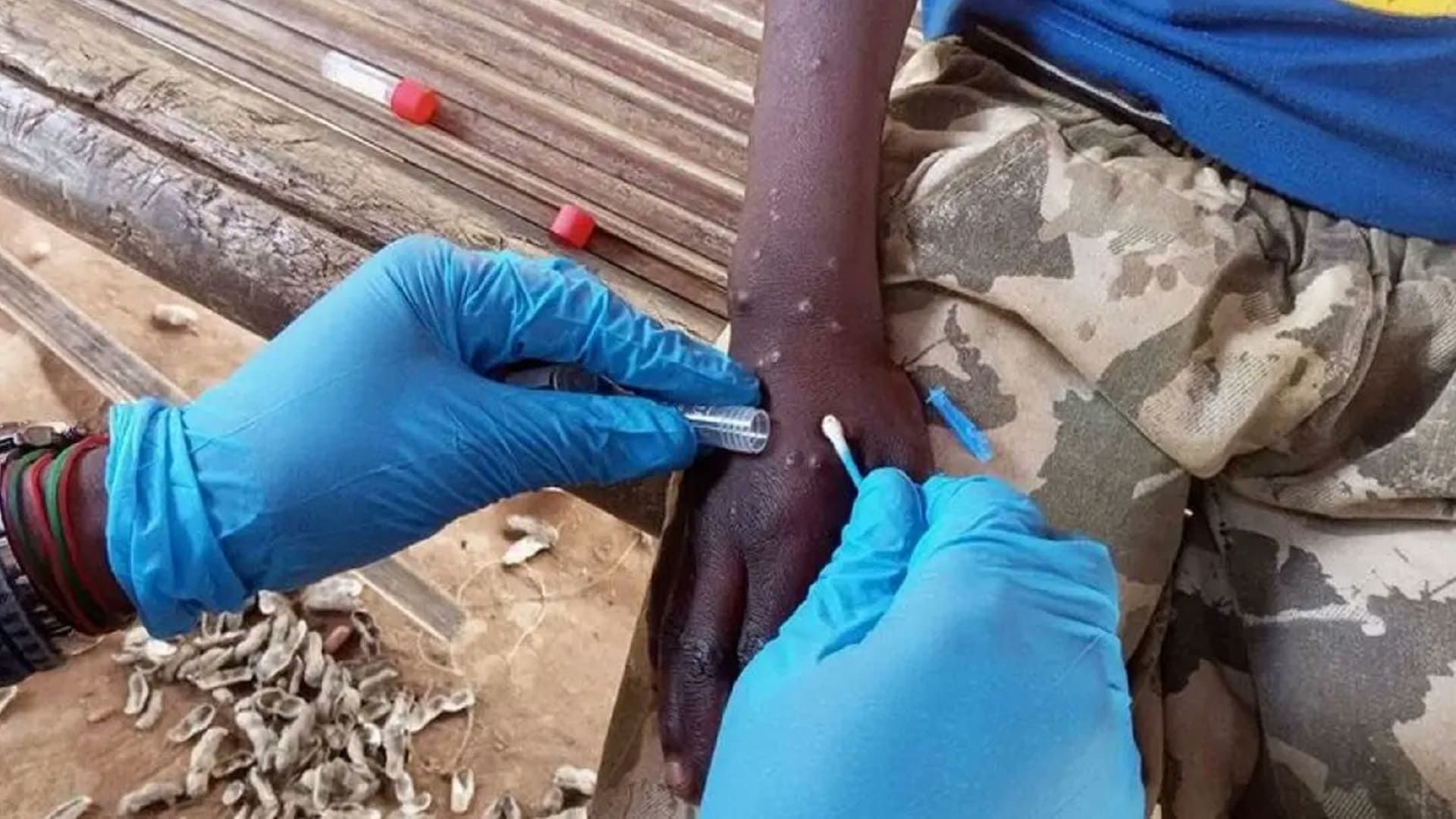 Brote de viruela símica en Santa María Huatulco